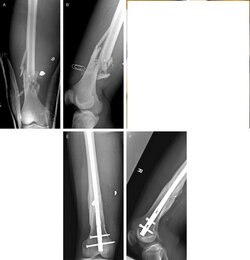 femur.jpg