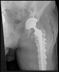 femur.jpg