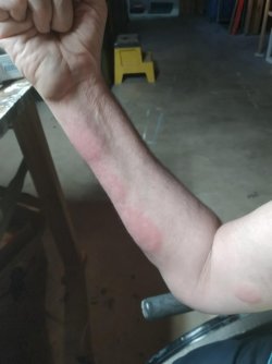 Four ant bites, itchy!.jpg