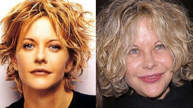 Meg-Ryan-Plastic-Surgery-Gone-Wrong.jpg